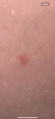 Unidentifiable insect bite/skin irritation