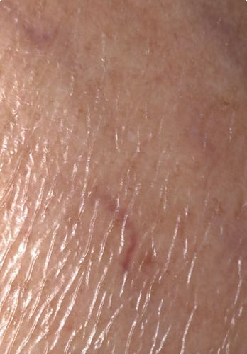 Itch mite