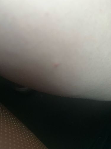 Unidentifiable insect bite/skin irritation