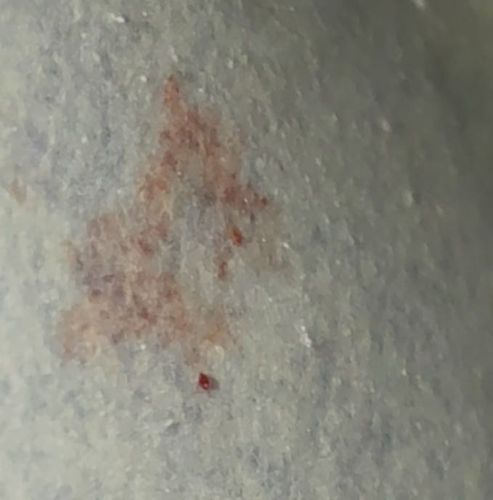 Chigger (Larval Trombiculid Mite)