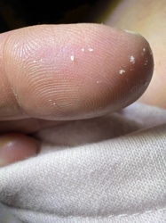 Dandruff flakes or dry skin