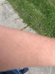 Unidentifiable insect bite/mark