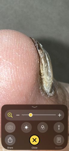 Tunga penetrans (Chigoe flea / Jigger flea)