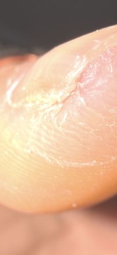 Itch Mite or Scabies Mite