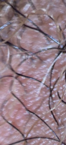 Pubic Louse (Crab Louse)