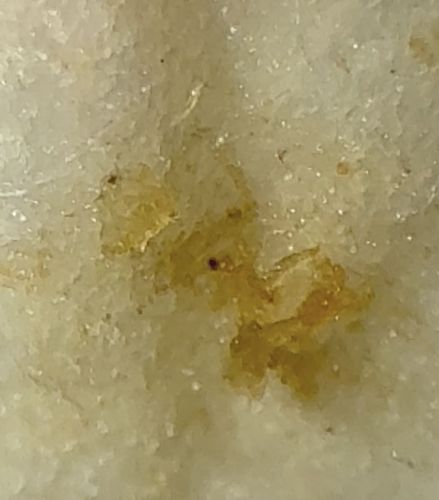 Earwax (Cerumen)