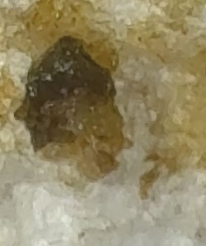 Earwax Impaction (Not an insect)