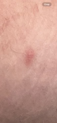 It is not possible to identify an insect from this image. The image shows a small red mark on human skin, possibly an insect bite, but no insect is visible for identification.
