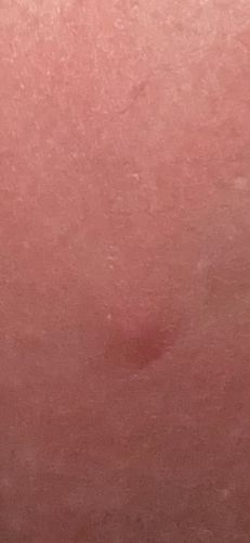 Unknown skin irritation/bite mark