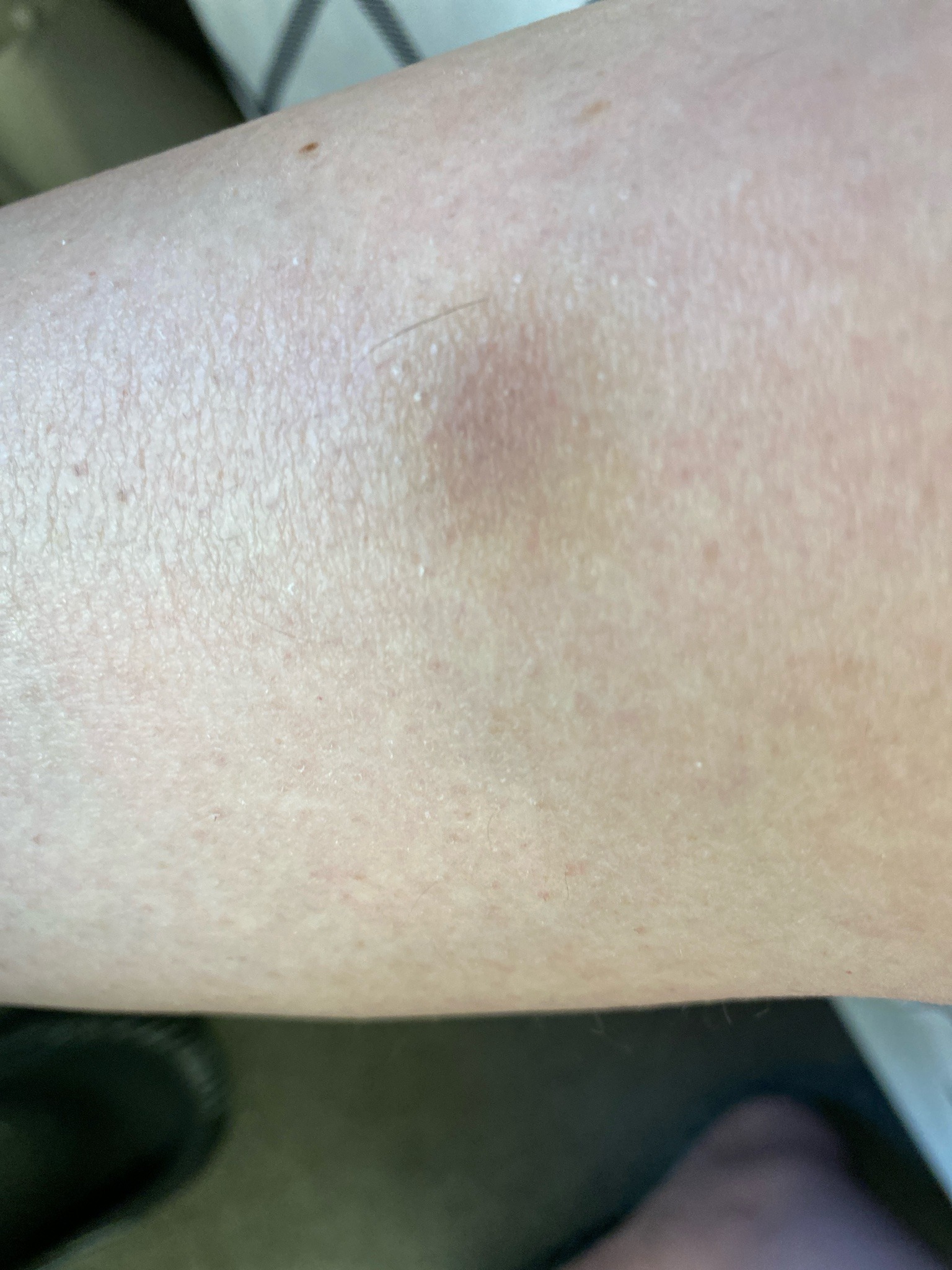 Undetermined (Bite/Sting)