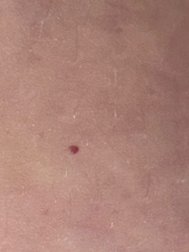 Cherry Angioma