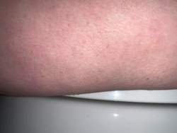 Human skin with rash/irritation