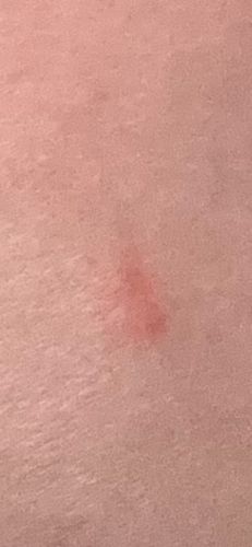 Unknown insect bite (Likely Mosquito, Flea, or similar biting insect)