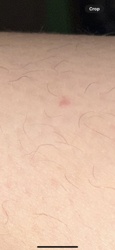 There is no identifiable bug or insect in the image. The image shows human skin with hair follicles and a small red mark, possibly an irritation, a small bite mark, or a minor skin lesion. Without a visible insect, identification is not possible.