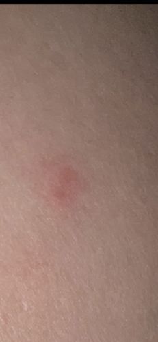 Mosquito (Mosquito Bite)