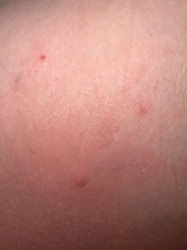Mosquito (bite marks)