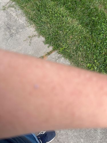 Unidentifiable insect bite/mark