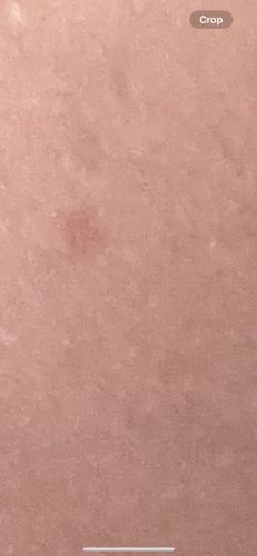 There is no identifiable bug or insect in the image provided. The image appears to show a small, reddish mark on human skin.
