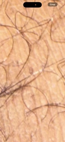 Human Lice (Head, Body, or Pubic Lice)