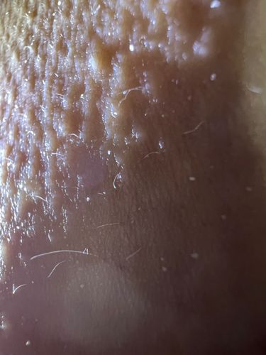 Itch mite (Scabies mite)