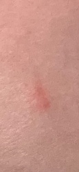 Undetermined insect (bite mark)