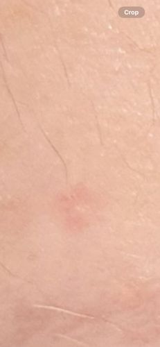 Chigger (mite larva)