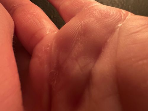 Itch mite (Scabies mite)