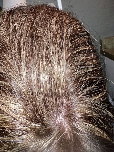 Head Louse (plural: Head Lice)