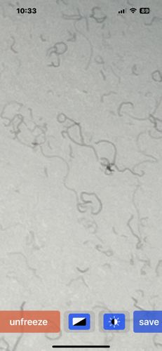 Eye Floaters (Muscae Volitantes)