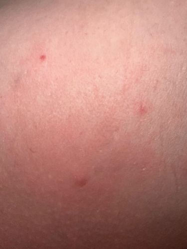 Mosquito (bite marks)