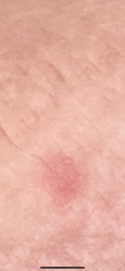 Tick bite (Lyme disease rash)