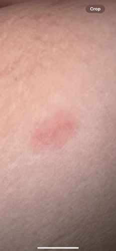 Unknown insect bite (Likely Mosquito, Flea, or similar biting insect)