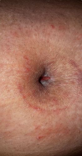 Human Botfly (Larva)
