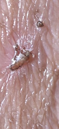 Scabies Mite (also known as the Itch Mite)