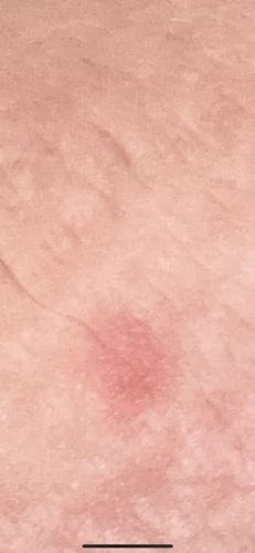 Tick bite (Lyme disease rash)