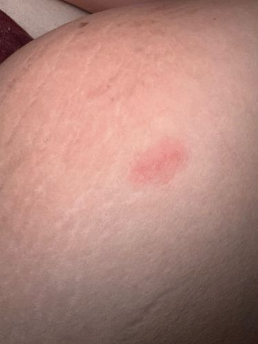 Unknown bite mark