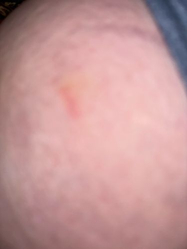 Unidentifiable Mark on Skin