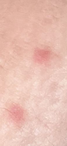 Flea (bite)