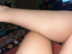 No insect identified