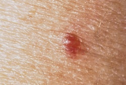 Chigger (Harvest Mite Larva)