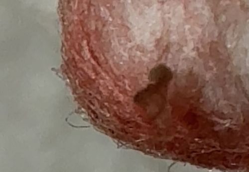 Pubic Louse (Crab Louse)