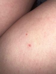 There is no insect visible in the image. The image shows skin with several small, red marks consistent with insect bites or other minor abrasions or irritations, but no actual insect can be identified.