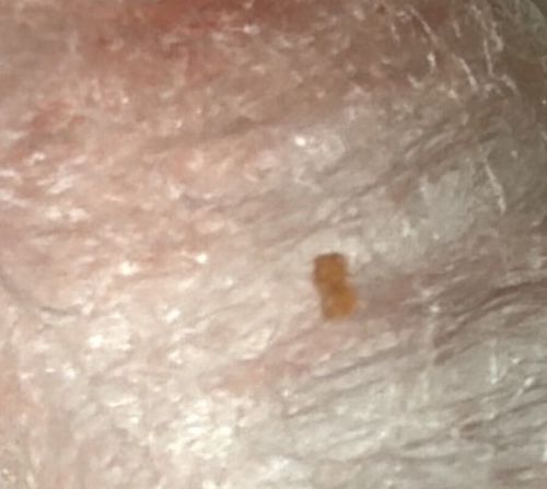 Pubic Louse (Crab Louse)