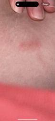 Mosquito (bite)