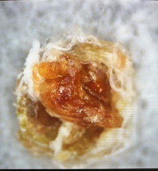 Earwax Plug with possible insect fragment