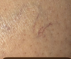 Itch mite