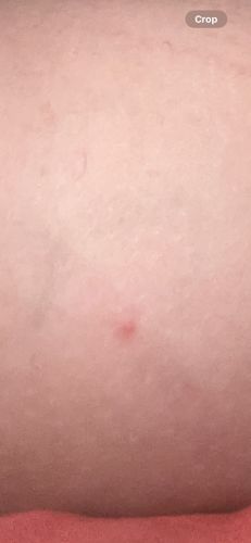 N/A - Image shows a bite/rash, not an insect.