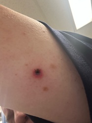 Human Botfly (or other botfly larvae bite)