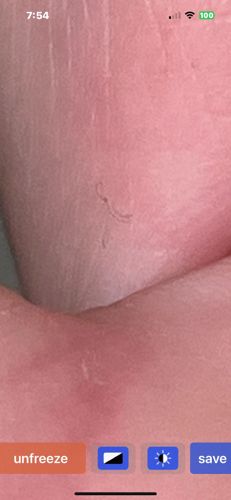 Hookworm (manifesting as Cutaneous Larva Migrans)