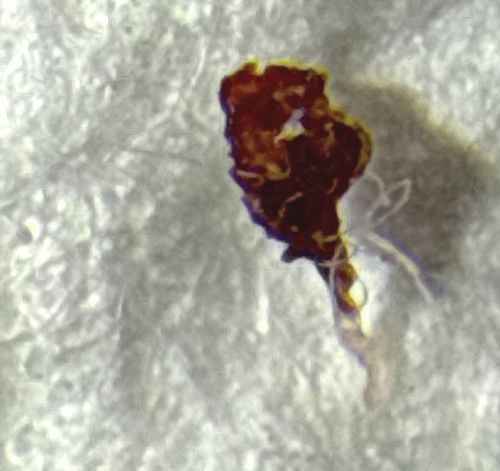 Skin Scale or Scab (Not an insect)